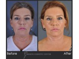 Blepharoplasty - Front 