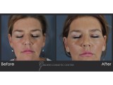 Blepharoplasty - Eyes Closed