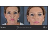 Blepharoplasty - Eyes Open