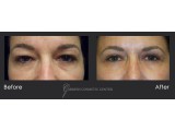 Blepharoplasty