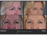 Upper Blepharoplasty