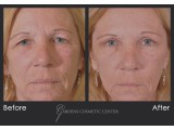 Upper Blepharoplasty