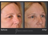 Upper Blepharoplasty