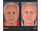 Lower Blepharoplasty with Fat Transfer
