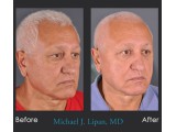 Lower Blepharoplasty with Fat Transfer