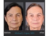 Lower Blepharoplasty 