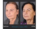 Lower Blepharoplasty