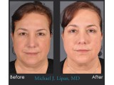 Lower Blepharoplasty