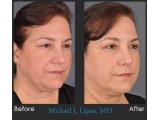 Lower Blepharoplasty