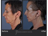 Facelift