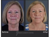 Revision Facelift with Fat Transfer