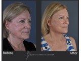 Revision Facelift with Fat Transfer