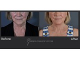 Revision Facelift with Fat Transfer