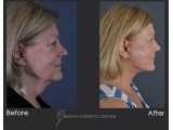 Revision Facelift with Fat Transfer