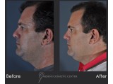 Post Traumatic Crooked Nose Correction for Breathing