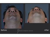 Post Traumatic Crooked Nose Correction for Breathing