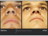 Rhinoplasty