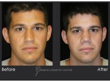 Rhinoplasty