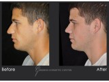 Rhinoplasty