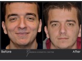 Rhinoplasty