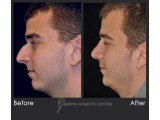 Rhinoplasty