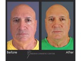 Rhinoplasty - correction of tip drooping and tip asymmetry 