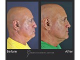 Rhinoplasty - correction of tip drooping and tip asymmetry 