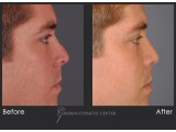 Rhinoplasty