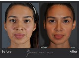 Rhinoplasty