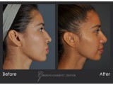 Rhinoplasty