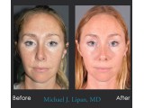 Rhinoplasty