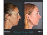 Rhinoplasty