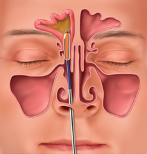 Balloon Sinus Dilation west palm beach