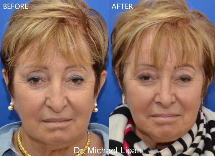 Rhinoplasty Nose Job