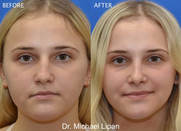 Rhinoplasty Nose Job