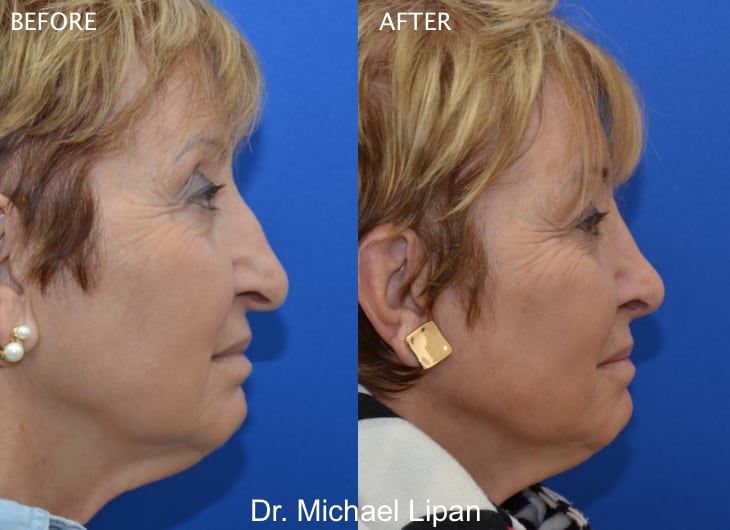 Rhinoplasty Nose Job