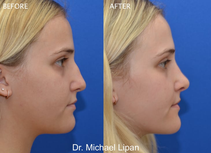 Rhinoplasty Nose Job