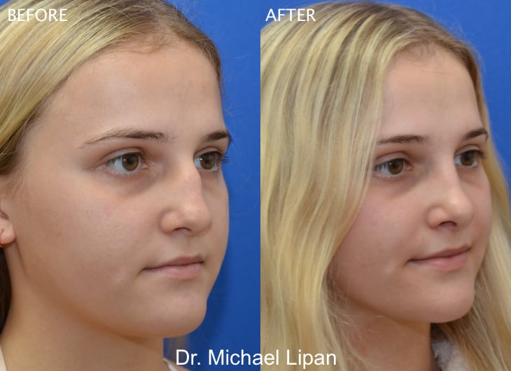 Rhinoplasty Nose Job