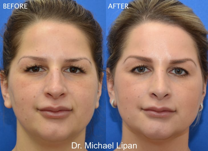 Rhinoplasty Nose Job