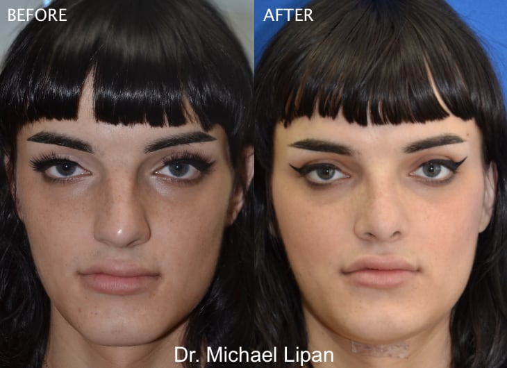 Rhinoplasty Nose Job