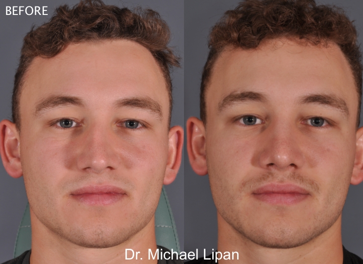 Rhinoplasty Nose Job