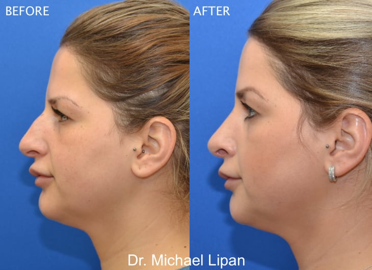 Rhinoplasty Nose Job