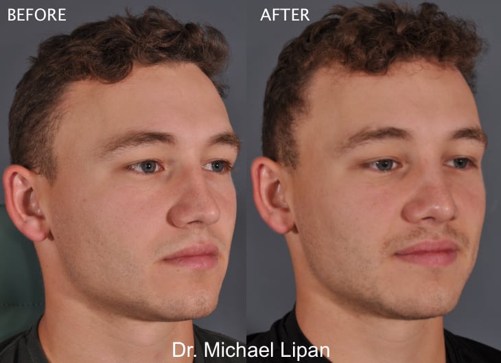 Rhinoplasty Nose Job