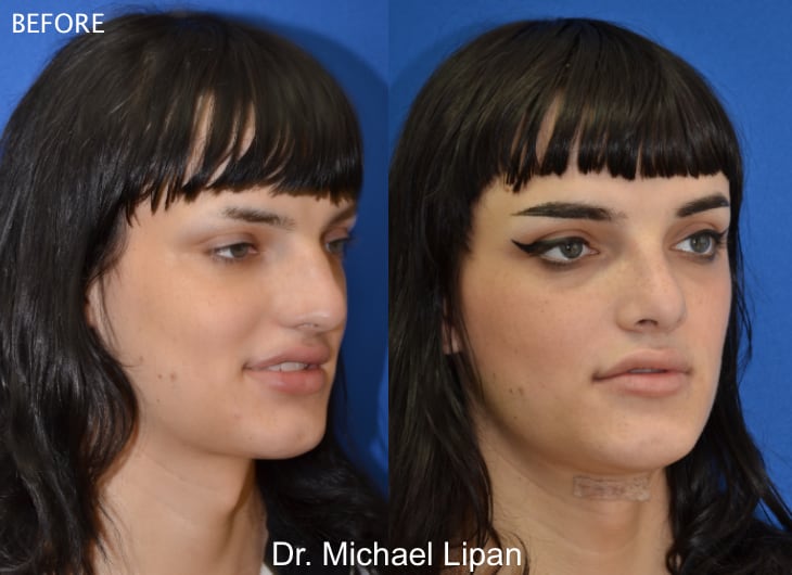 Rhinoplasty Nose Job