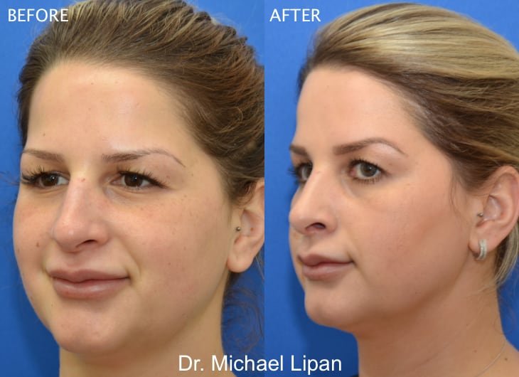 Rhinoplasty Nose Job