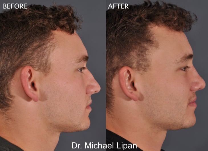 Rhinoplasty Nose Job