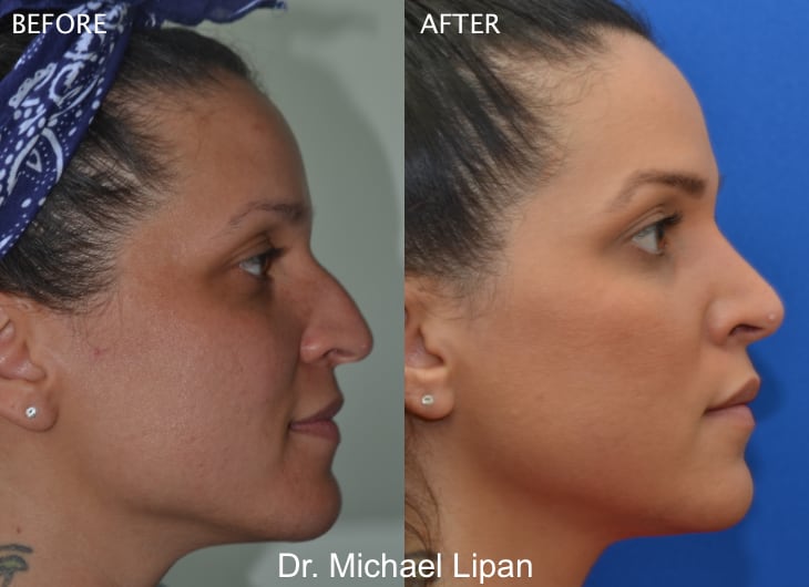 Rhinoplasty Nose Job