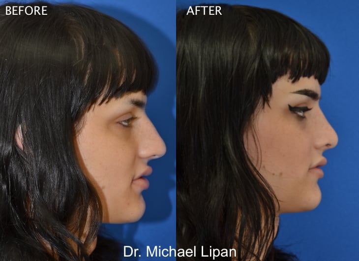 Rhinoplasty Nose Job