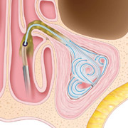 Balloon Sinuplasty - Step 3